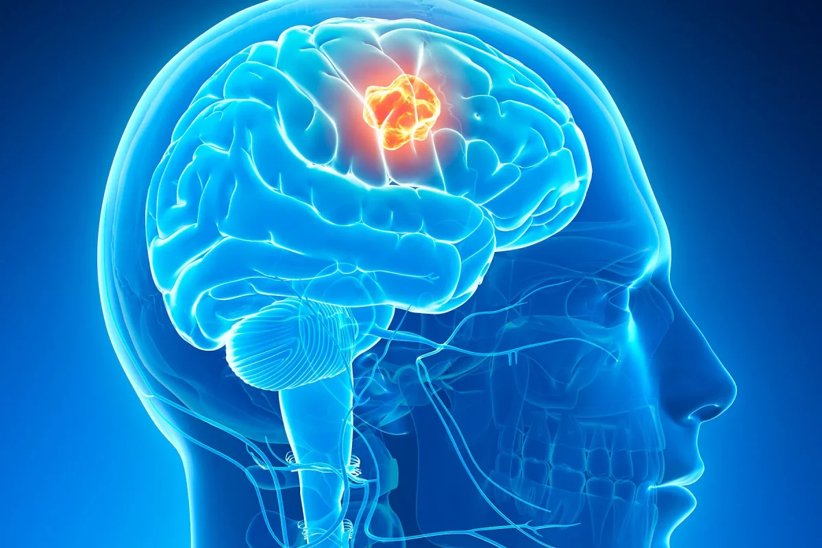 سرطان مغز Brain Cancer