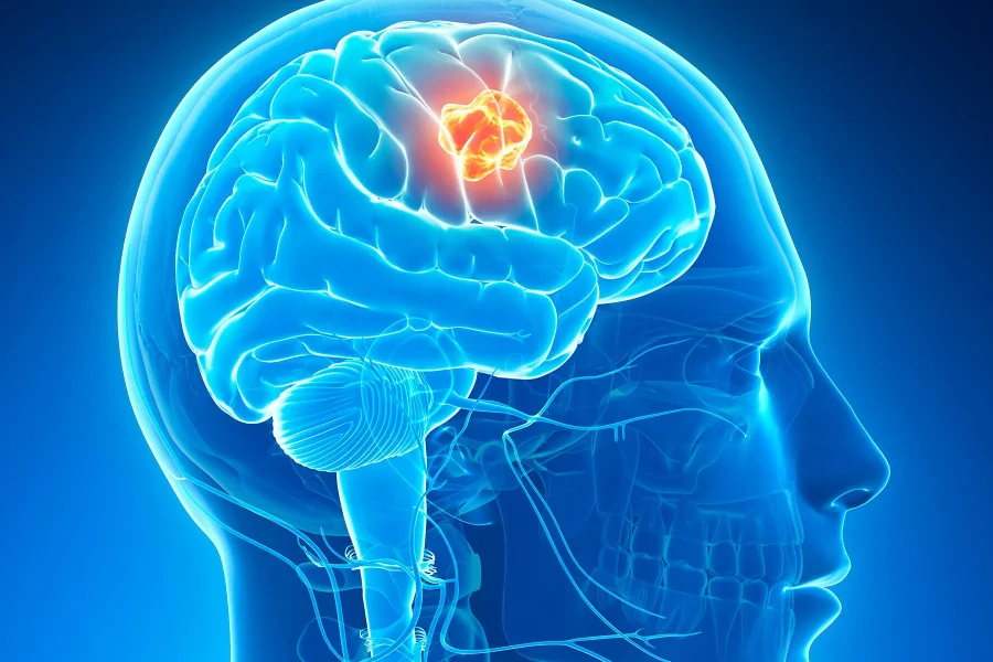 سرطان مغز Brain Cancer